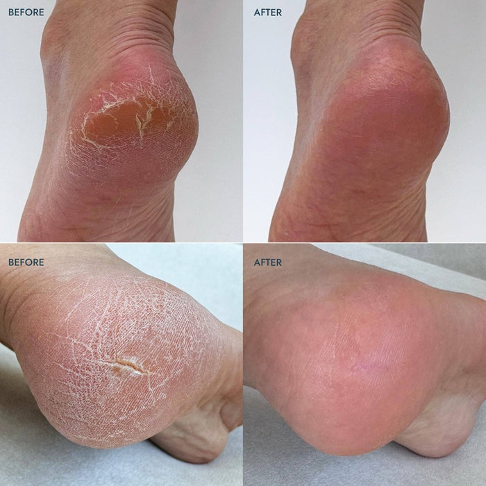 Before and after heel repair treatment showing cracked dry heels transformed to smooth soft skin